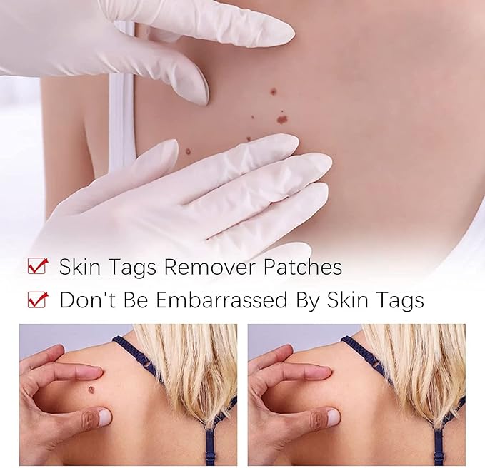 Tags and Mole Remover