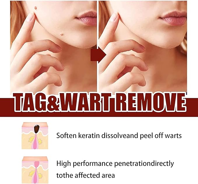 Tags and Mole Remover